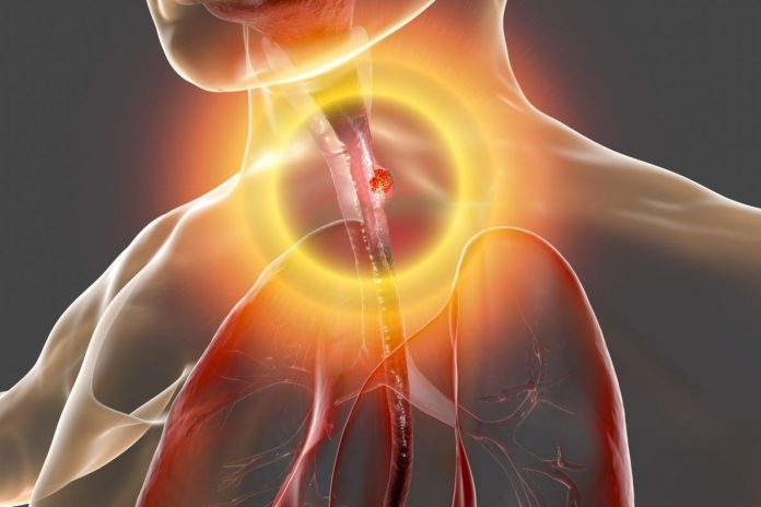 Tumore esofago: approvato nivolumab come trattamento