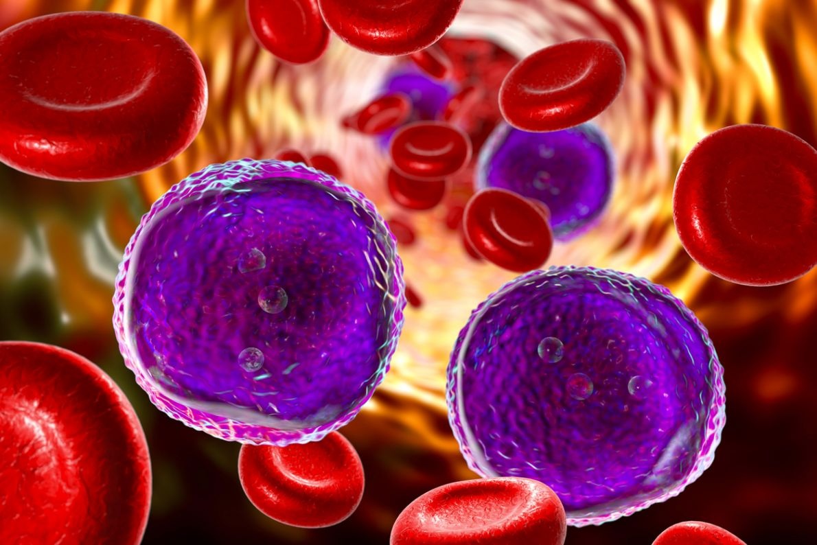 Leucemia acuta mieloide, conferme per CPX-351 - Sanihelp.it