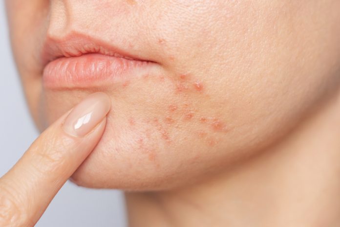 La dermatite periorale si può combattere anche con i rimedi naturali